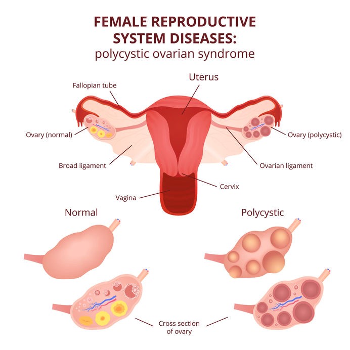 PCOS illustration